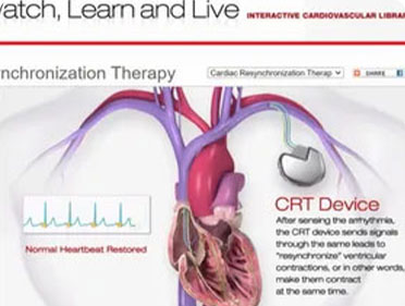 Cardiac Resyncronization Therapy Image